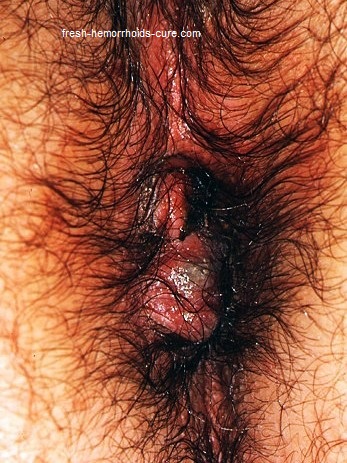 Hemorrhoid Photos