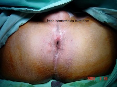 Pictures of Hemorrhoids