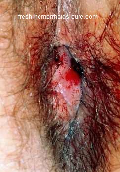 Hemorrhoid Photos