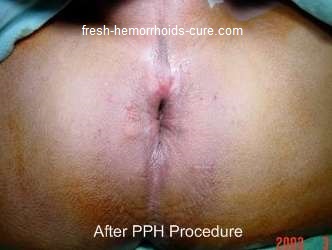 Hemorrhoid Picture