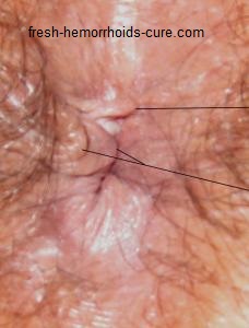 Hemorrhoid Skin Tag