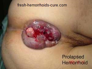 Hemorrhoids Photos