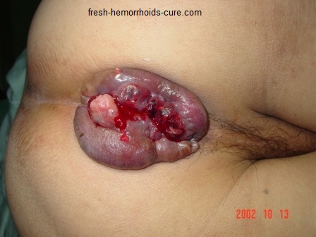 Pictures of Hemorrhoids