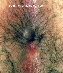 Hemorrhoid Photos