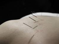 Acupuncture and Hemorrhoids