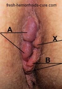 Hemorrhoid Pictures