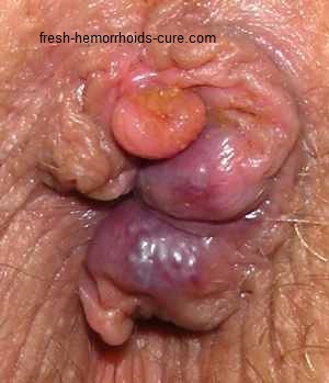 Hemorrhoids Photos