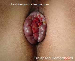 Hemorrhoids Photos