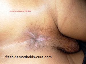 Pictures of Hemorrhoids